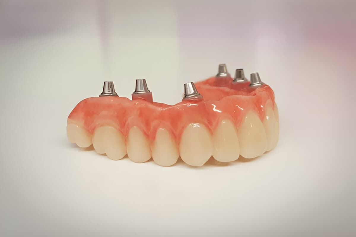 Modello 3D degli impianti All on 6 – Struttura dentale su sei impianti per una maggiore stabilità.