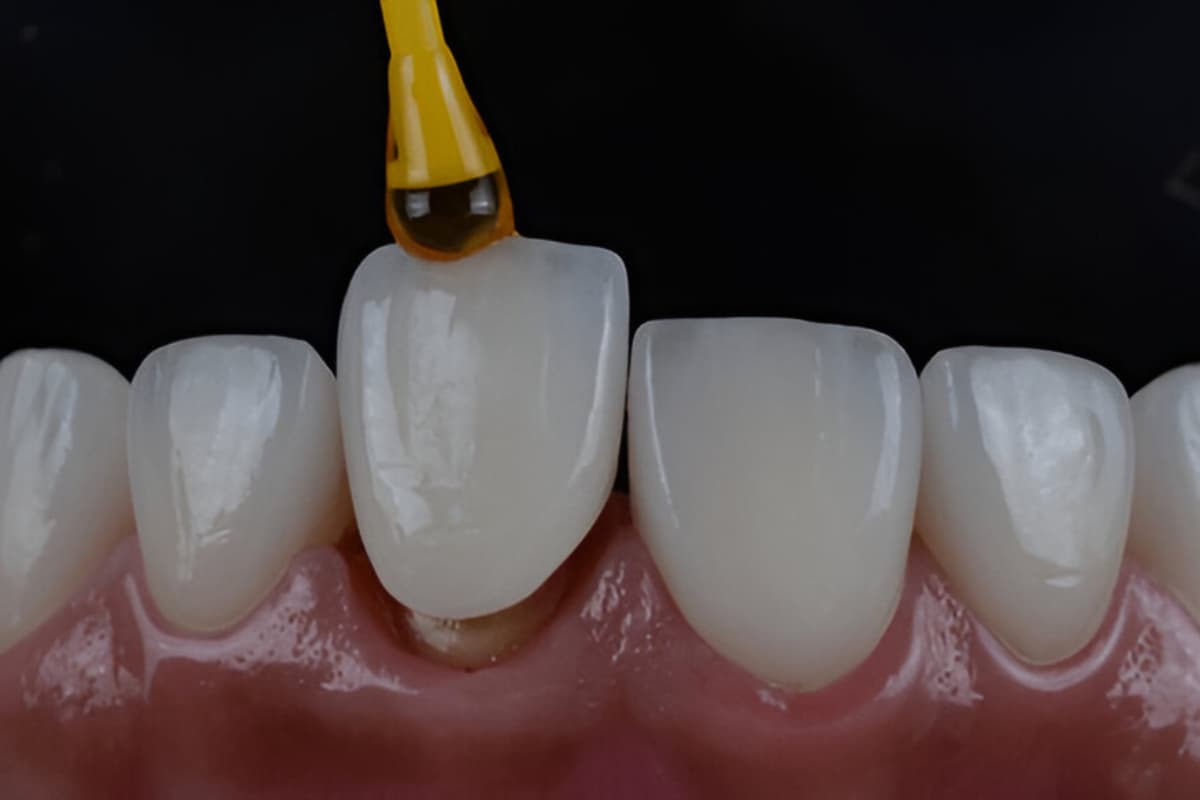 Laboratorio odontotecnico in Albania che realizza corone dentali personalizzate