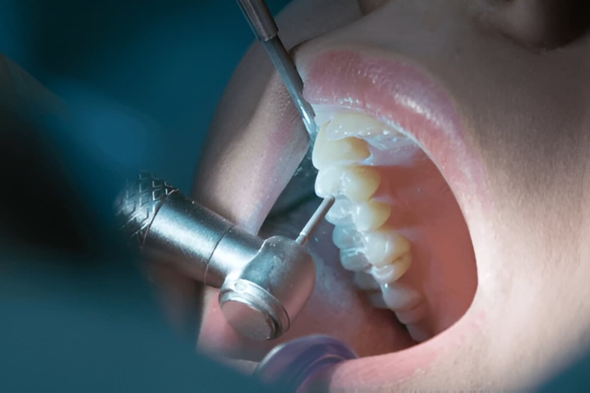Strumenti endodontici moderni utilizzati per la devitalizzazione di un dente