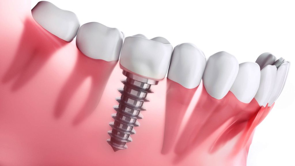 Wondering how long dental implants last? Discover expert insights, detailed analysis, and why Albania is a top destination.