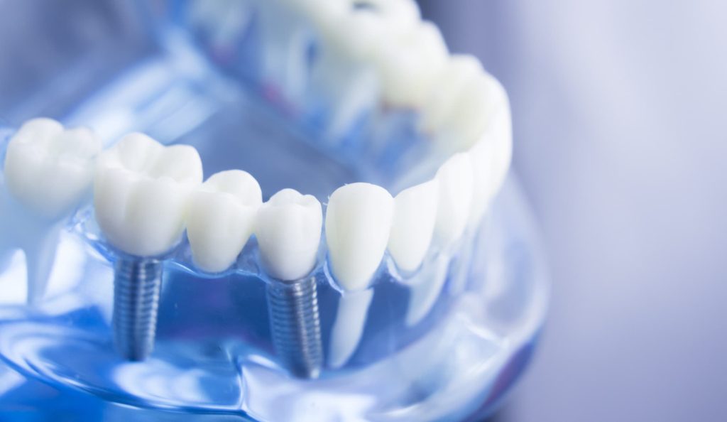 Scopri le migliori marche di impianti dentali nel 2025. Guida completa sui materiali, procedure e perché scegliere impianti di qualità.