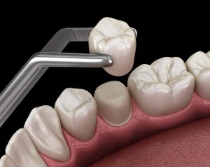Di cosa sono fatte le corone dentali? Scopri i materiali più usati, vantaggi, svantaggi, e perché scegliere una corona dentale adatta a te.