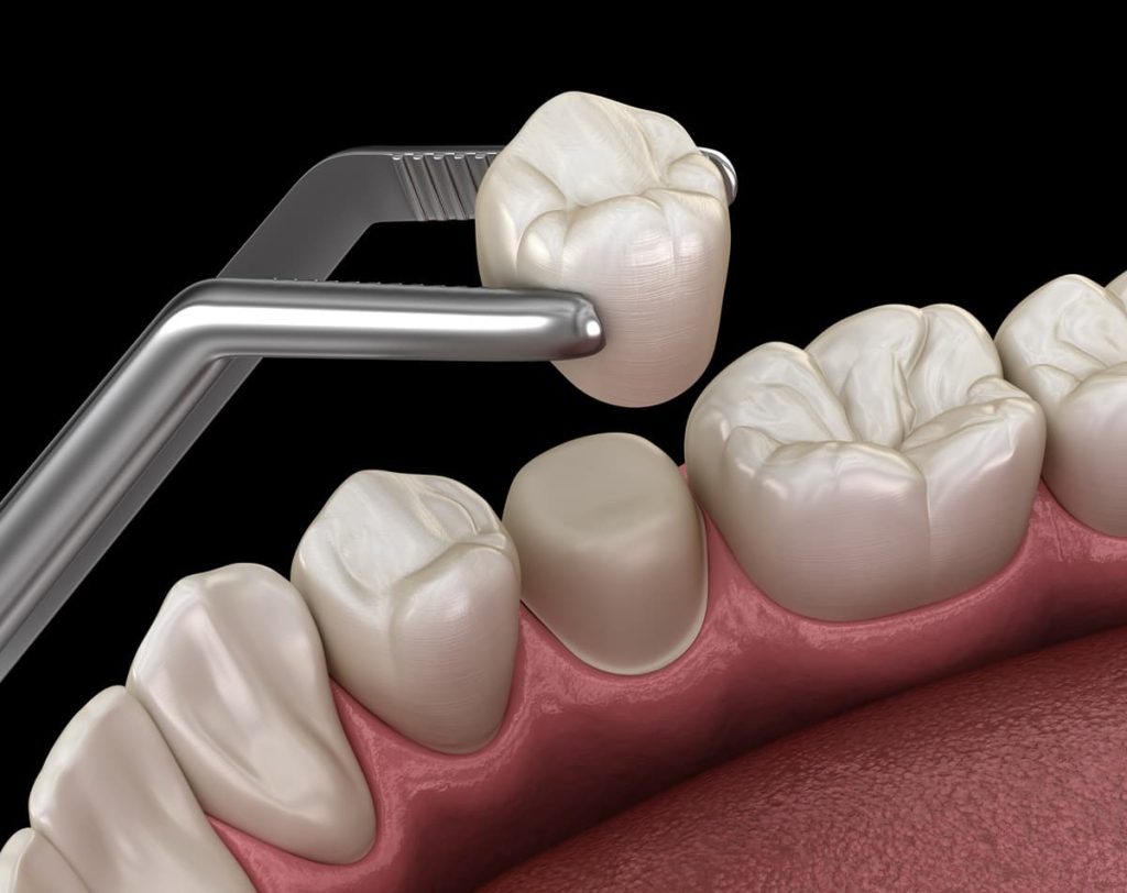 What are dental crowns made of? Discover the materials, procedure, expert opinions, and which crown type is right for your smile.