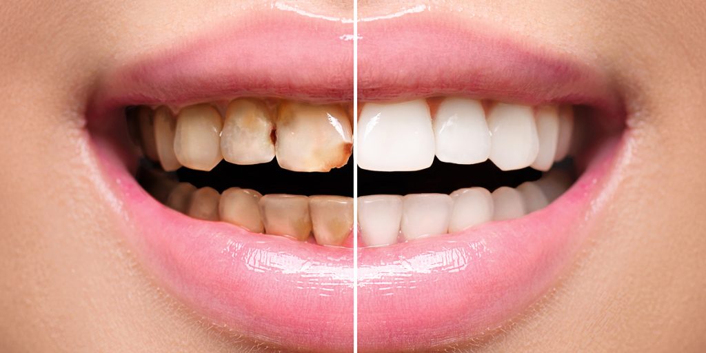 Considering full mouth restoration in Albania? Discover the treatments involved, travel tips, and how to save up to 70% on your new smile.