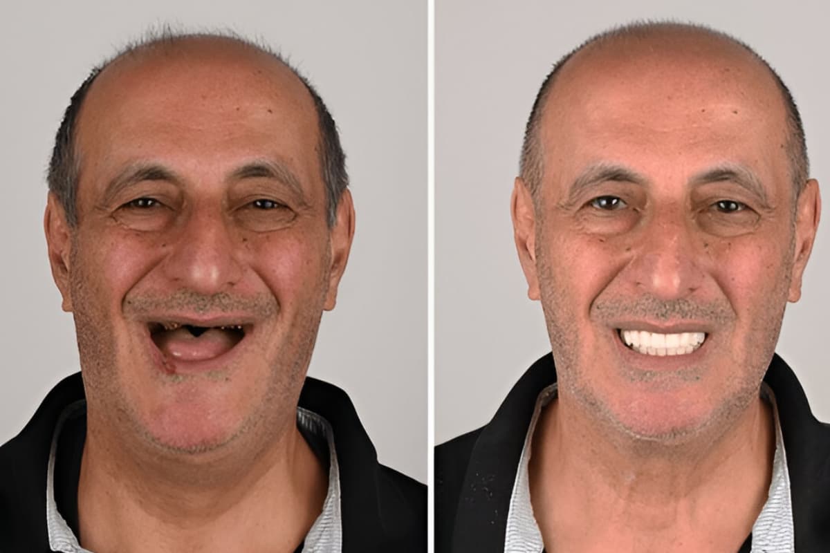 Before and after dental implants in Albania for a full smile restoration.