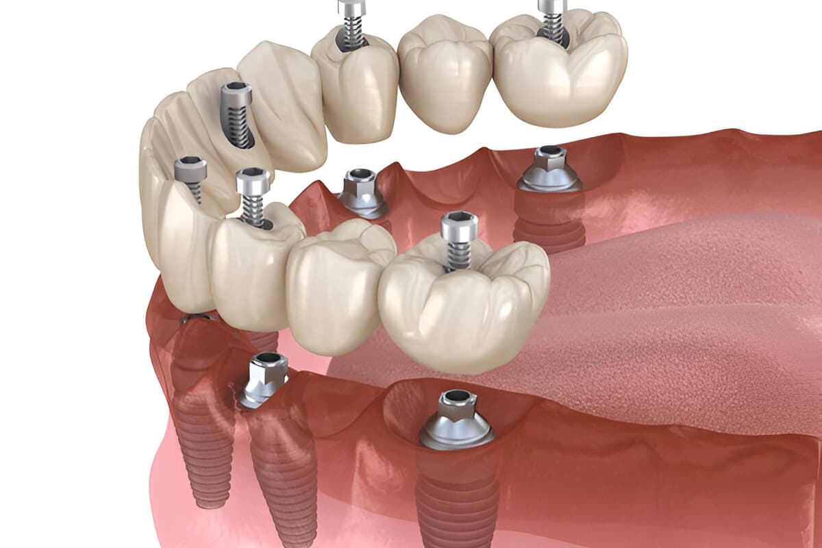 3D diagram of all on 6 dental implants with screw-retained bridge and six fixtures in lower jaw.