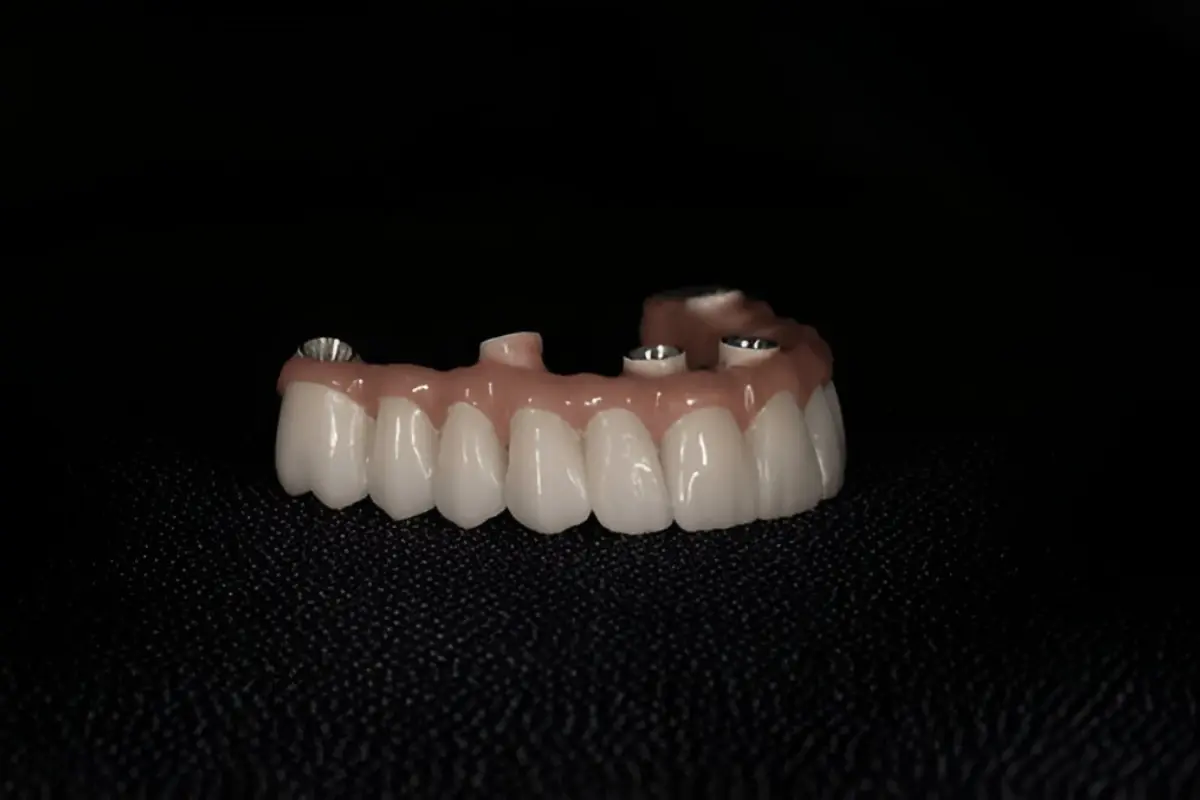 Upper arch prosthesis with screw access holes for All on 4 Dental Implants, lab model view.