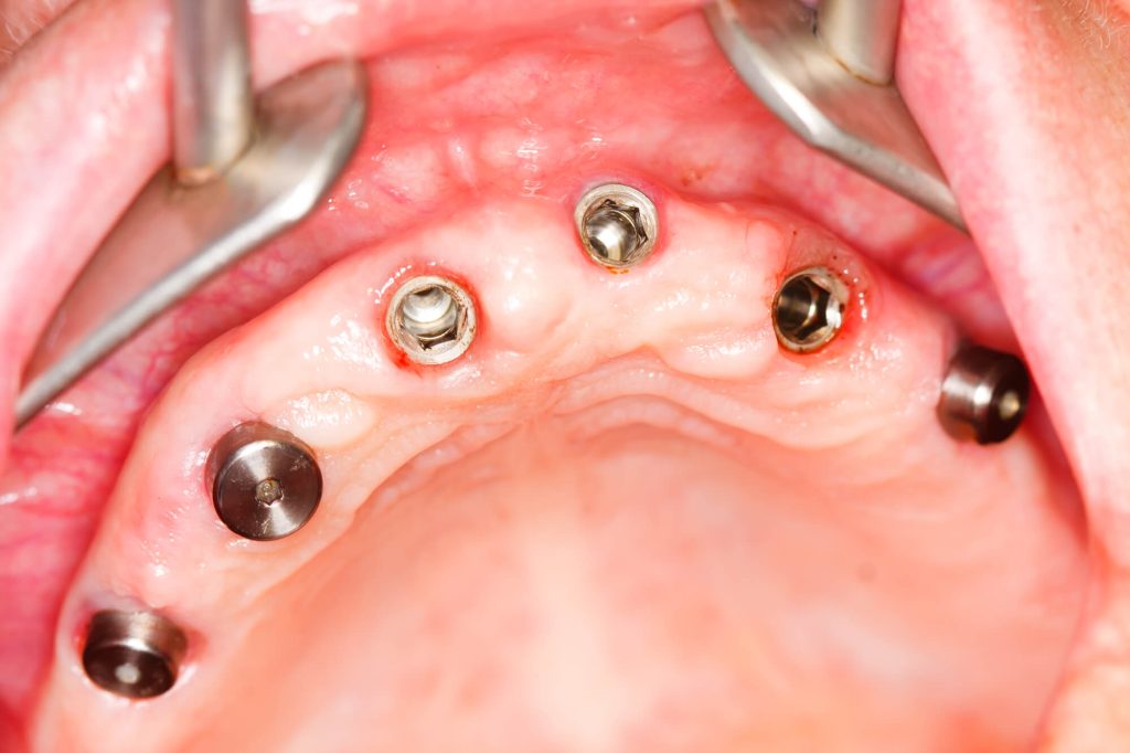 Scopri Cosa aspettarsi dopo gli impianti dentali: fasi di recupero, sintomi e consigli. Medaljon Dent Albania, specialisti in implantologia.