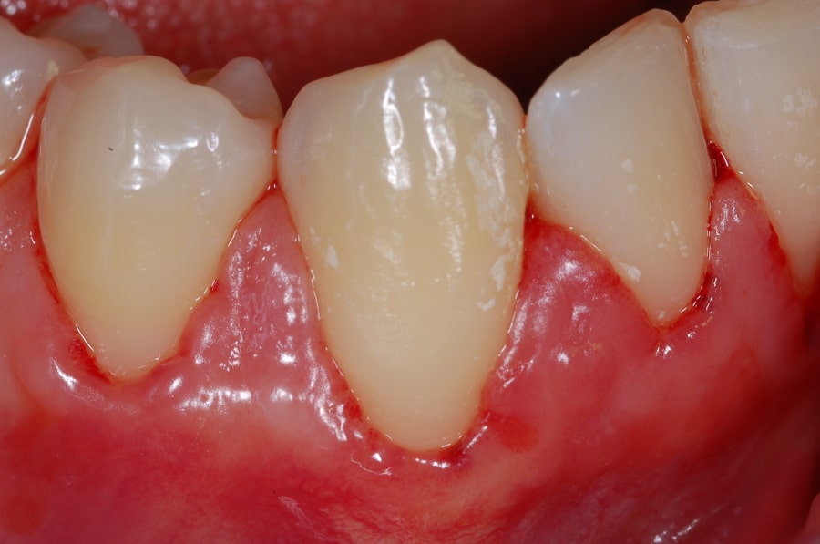 Scopri perché le gengive sanguinano, i trattamenti efficaci disponibili e i prodotti consigliati per la salute gengivale. Visita Medaljon Dent a Durazzo.