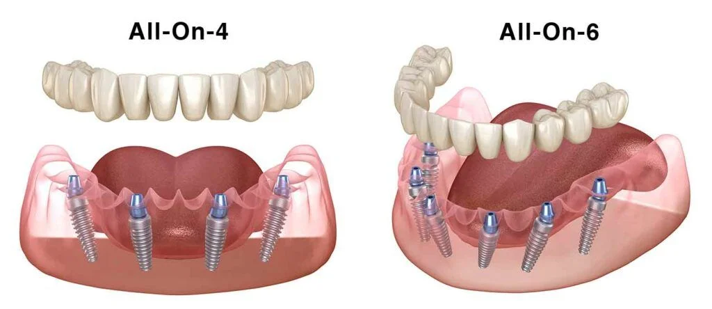 Scopri le differenze tra le soluzioni All-on-4 vs All-on-6 per denti fissi su impianti. Guida completa con vantaggi, limiti e indicazioni cliniche.