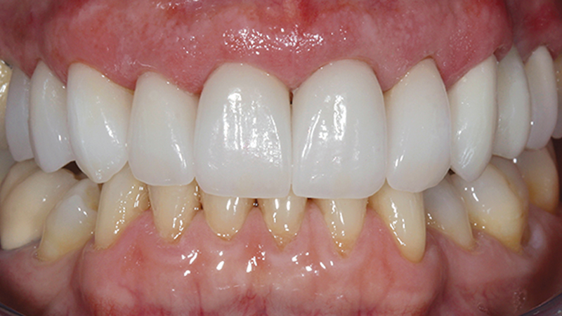 E-max crowns, made from lithium disilicate ceramic, are famous for their lifelike translucency and refined aesthetics.
