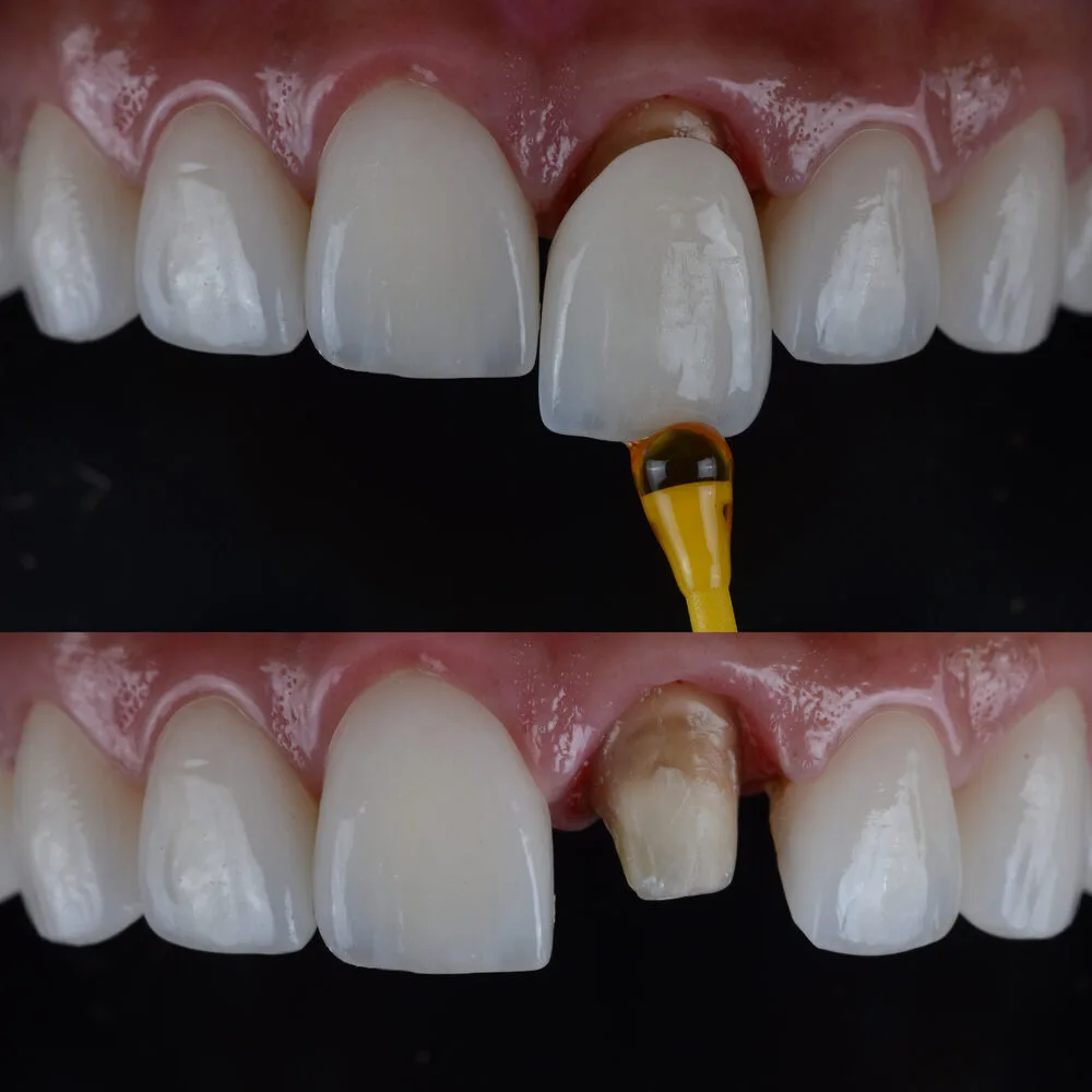 Wondering how long dental crowns last? Discover the average lifespan of zirconia, porcelain, and metal crowns, what affects their durability