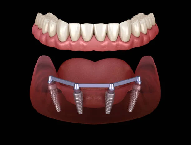 Il costo di un impianto dentale in Albania varia in base al tipo di trattamento e ai materiali utilizzati.
