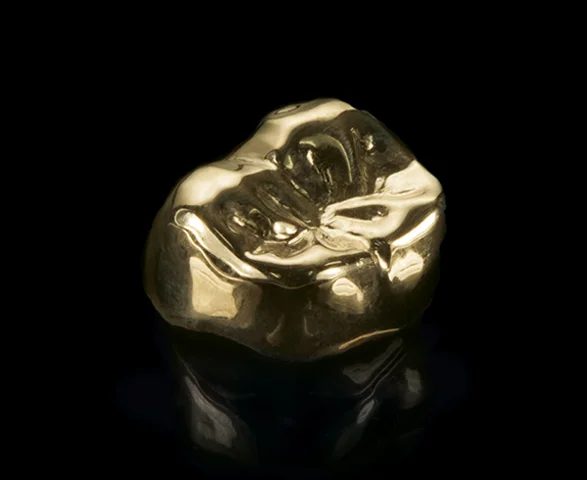 Though less commonly requested for cosmetic reasons, gold or metal alloy crowns remain a strong choice for molars and back teeth.