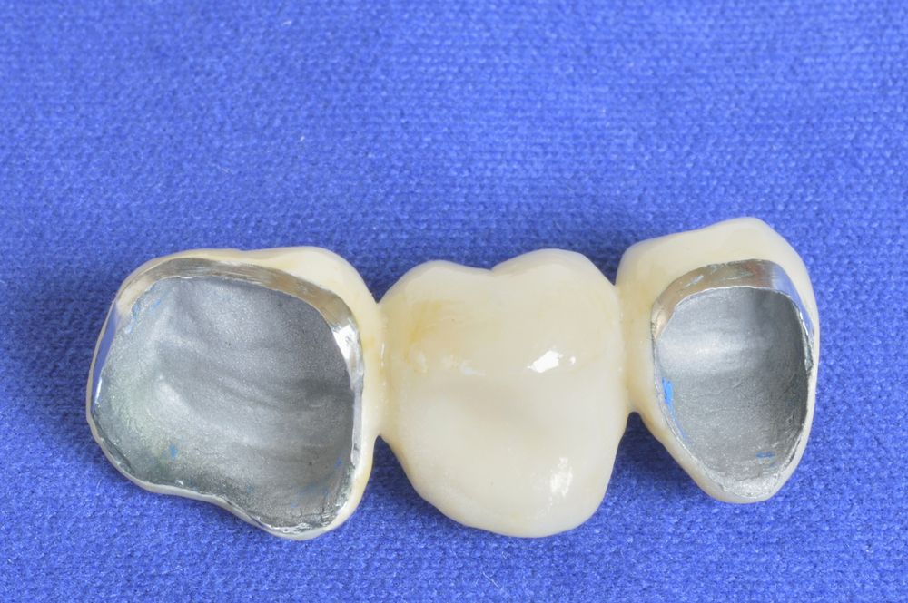PFM crowns are one of the oldest and most proven restorative solutions. They feature a metal base for durability and a porcelain layer for aesthetics.