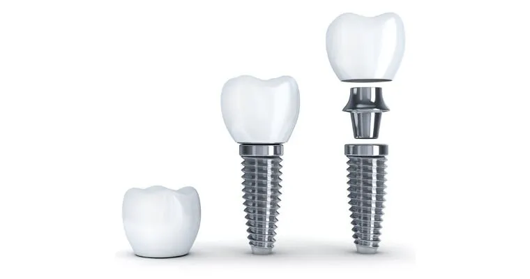 La durata media di un impianto dentale è 20–25 anni, ma in molti casi supera i 30 anni se mantenuto correttamente.
