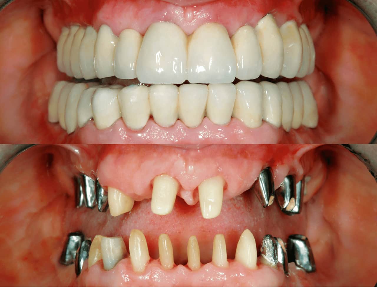 Benefits of Full Mouth Restoration in Albania: A Complete Guide to a New, Confident Smile