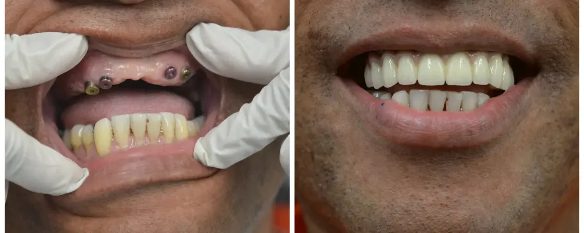 A full mouth restoration is a personalized treatment plan that rebuilds or replaces all teeth in both jaws. It combines several advanced procedures to restore function, health, and aesthetics.