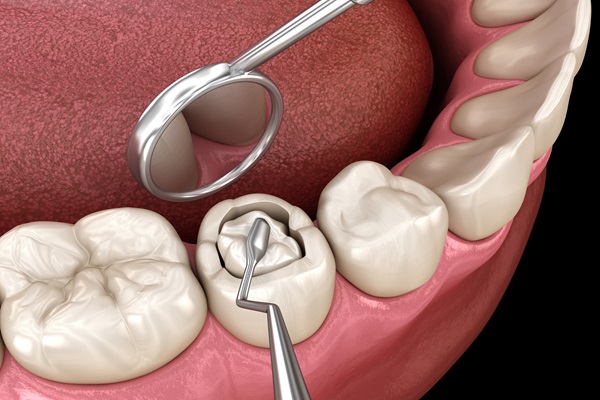A dental filling is a restorative material placed inside a tooth to fill a cavity or repair minor damage caused by decay, trauma, or wear. Once the decayed area is removed, the filling seals the tooth against bacteria, restores its natural shape, and reestablishes chewing strength.