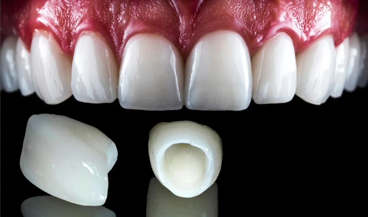 Zirconia (zirconium dioxide) is the most popular material for modern dental crowns.