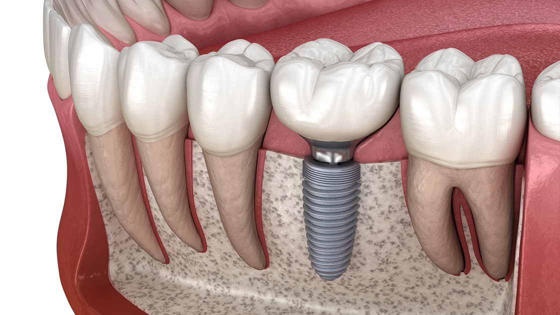 Sa Kushton një Implant Dentar në Durrës? Çmimet, Procesi dhe Garancia e Cilësisë në 2025