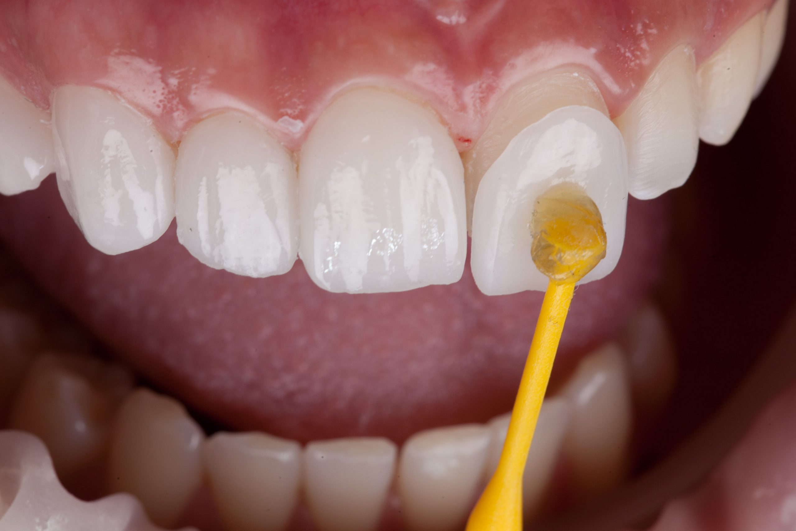Da Cosa Dipende il Prezzo delle Faccette Dentali

Il prezzo finale non è uguale per tutti. Ogni trattamento viene pianificato individualmente.